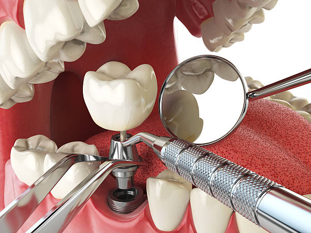 Best Emergency Wisdom Teeth Removal in Clarence, IA